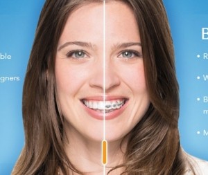 Invisible Orthodontics  Enhance Dental (03) 95338488