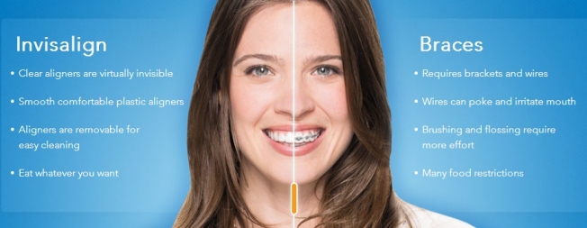 Braces vs Invisalign® - Melbourne MD