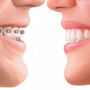 Invisalign or Braces? Invisalign is shown on the right