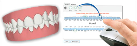 What is Invisalign Treatment?