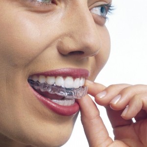 Clear Braces — Dentist Melbourne  Invisalign + Teeth Whitening + Clear  Braces