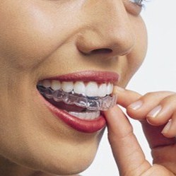 Invisalign SmartTrack Enhance Dental Melb 03 9533 8488