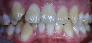Before Invisalign Before Invisalign