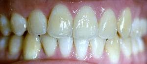 After Invisalign (click to enlarge) After Invisalign