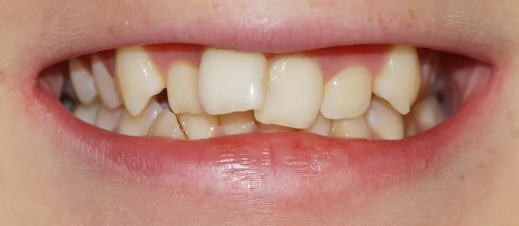 Gallery case 1: teeth before Invisalign treatment