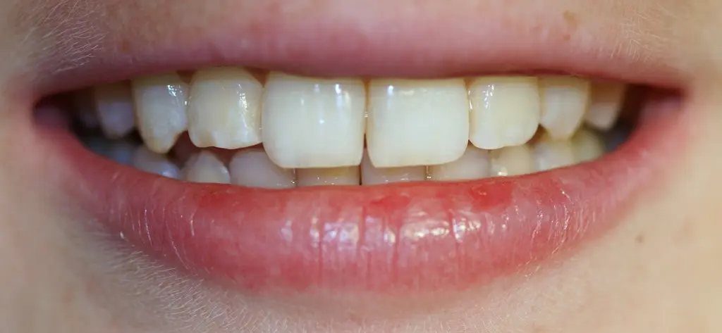 Gallery case 1: the same patient after Invisalign treatment
