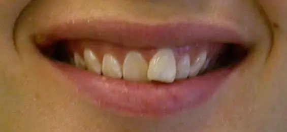 Gallery case 2: teeth before Invisalign treatment