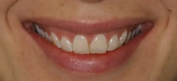 Gallery case 2: the same patient after Invisalign treatment
