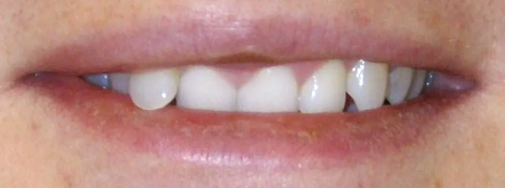 Gallery case 4: the same patient’s teeth before Invisalign treatment