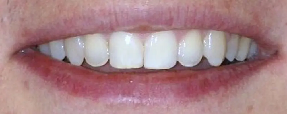 Gallery case 4: the same patient’s teeth after Invisalign treatment