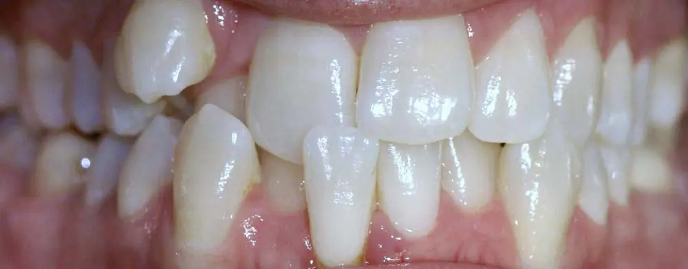 Gallery case 5: teeth before Invisalign treatment
