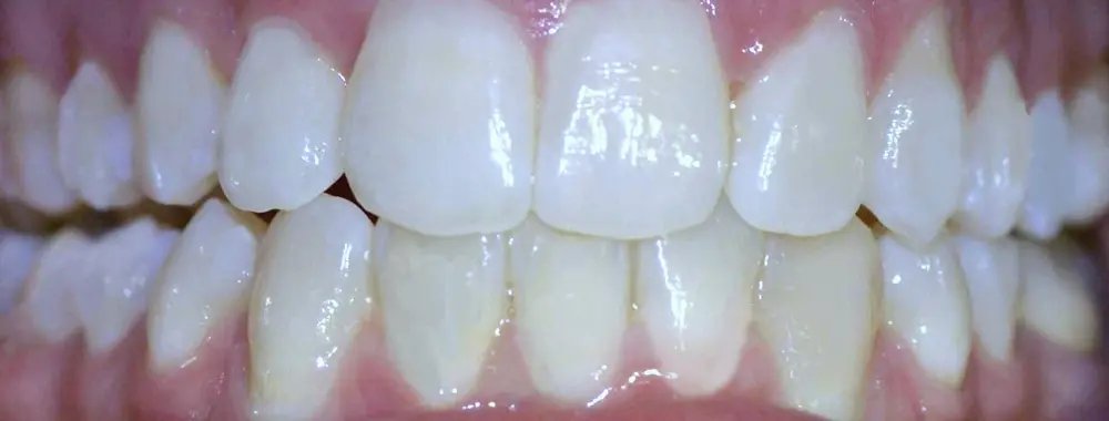 Gallery case 5: the same patient after Invisalign treatment