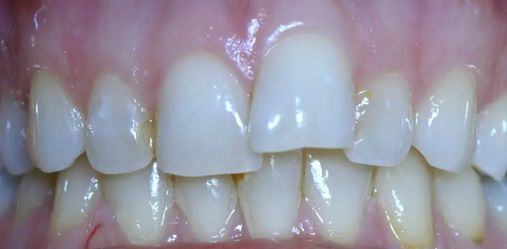 Gallery case 6: teeth before Invisalign treatment