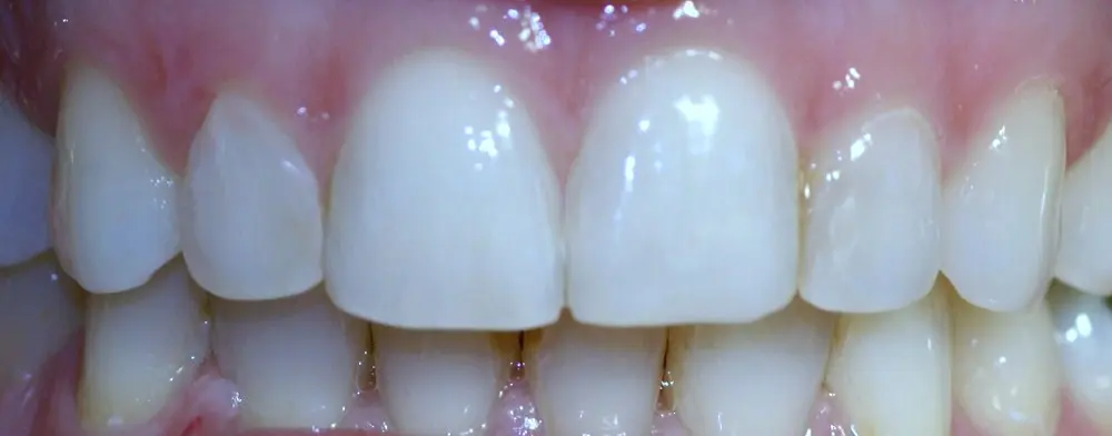 Gallery case 6: the same patient after Invisalign treatment
