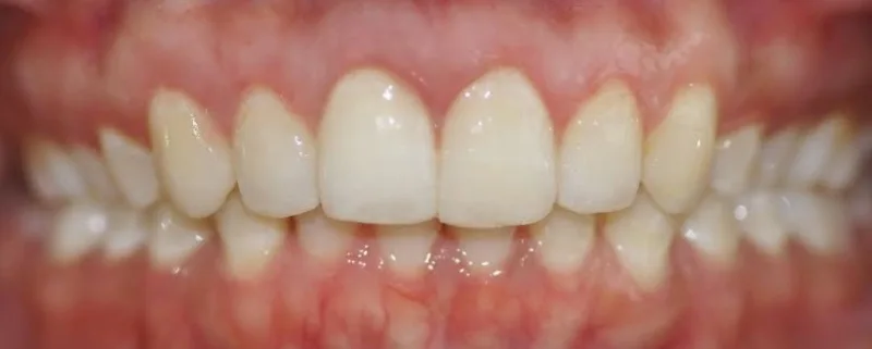 Gallery case 3: the same patient after Invisalign treatment