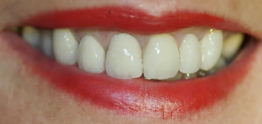 After porcelain crown treatment: Enhance Dental patient’s upper front teeth