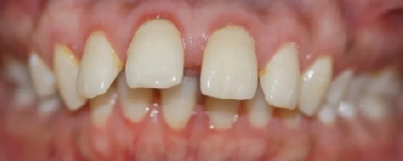 Gallery case 3: teeth before Invisalign treatment