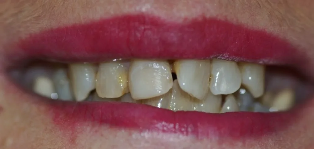 Before porcelain crown treatment: Enhance Dental patient’s upper front teeth