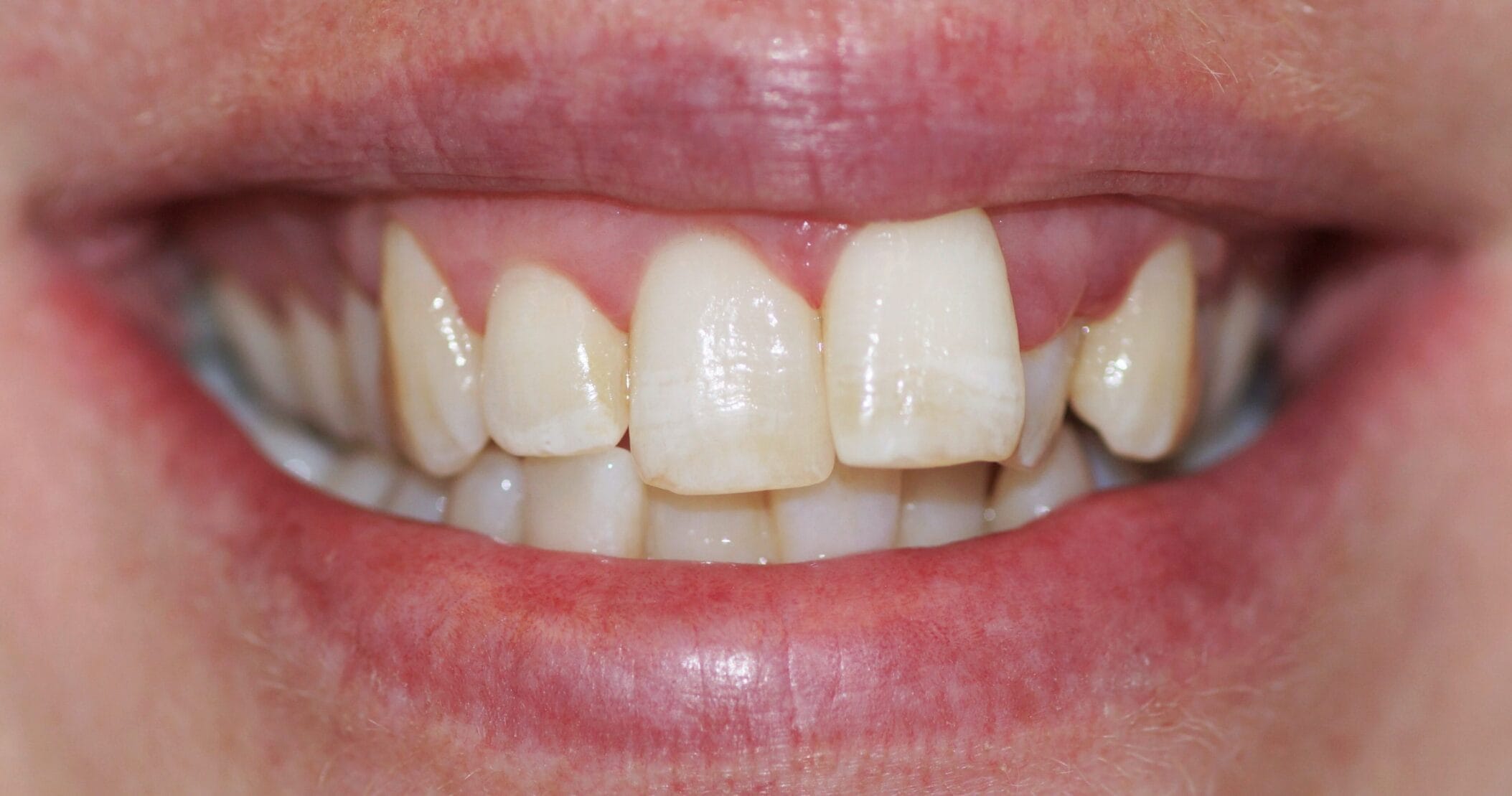 Before Invisalign treatment: a narrow smile and a prominent front tooth, case 02, Enhance Dental Melbourne