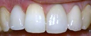 After Dental Implant Melbourne