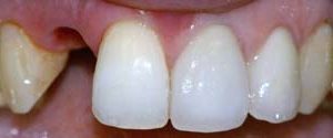 Before Dental Implant Melbourne