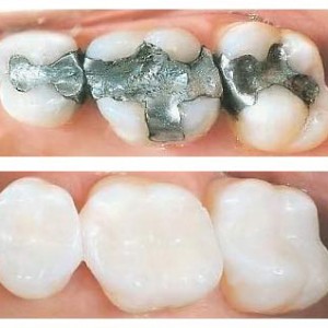 White fillings White fillings Melbourne