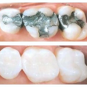 Porcelain and Zirconia crowns Melbourne