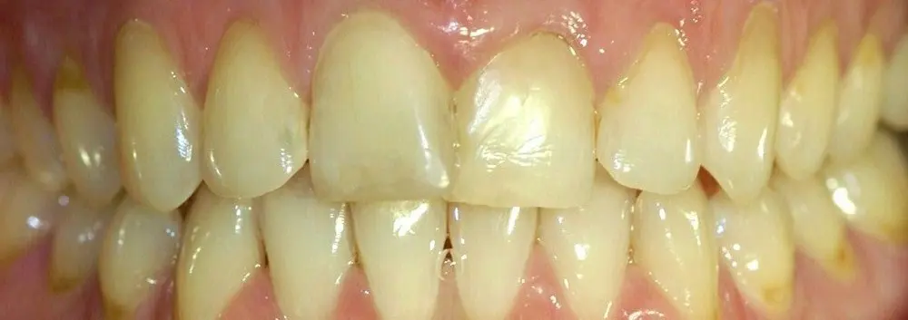 Before Invisalign and porcelain veneers in an Enhance Dental smile makeover case