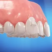 Illustration of an Invisalign aligner fitting over teeth and attachments
