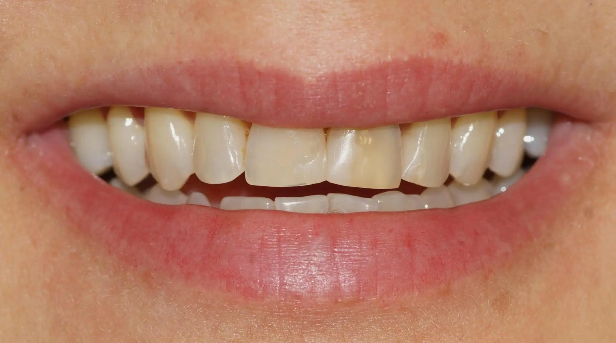 Before teeth whitening and eight upper-front resin veneers at Enhance Dental