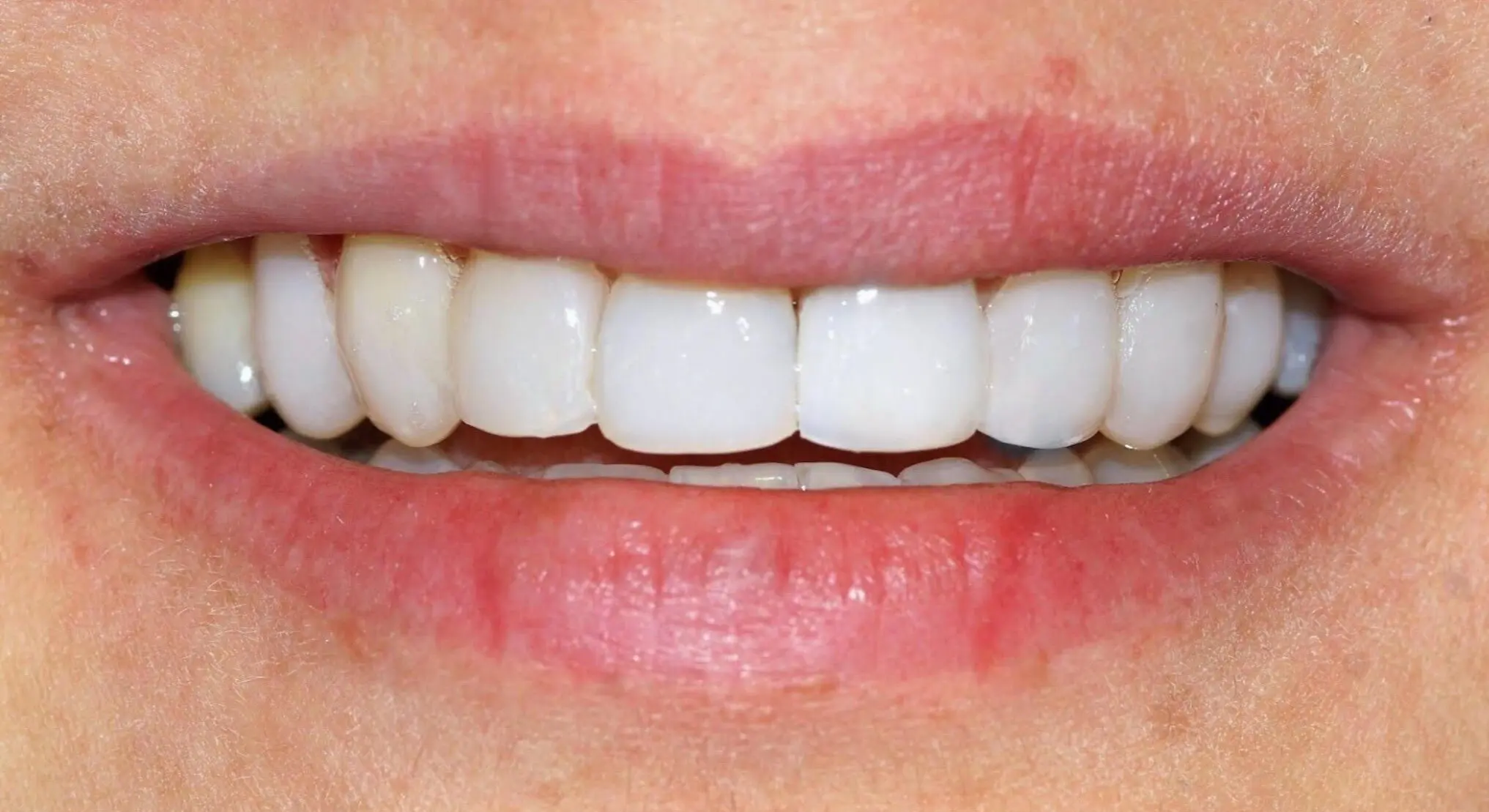 After eight upper-front resin veneers with whitening beforehand at Enhance Dental