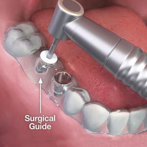 Implant Procedure
