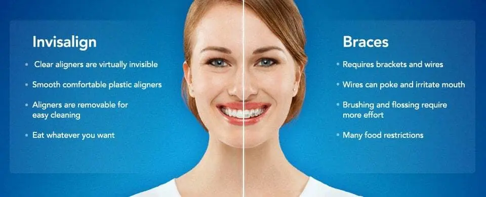 5 Great Advantages Of Invisalign Invisible Braces - Stirling