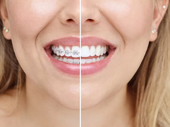 Side-by-side illustration comparing clear aligners and fixed braces