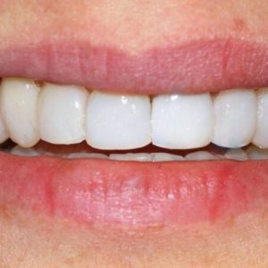 Resin Veneers Resin Veneers