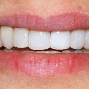 Resin Veneers