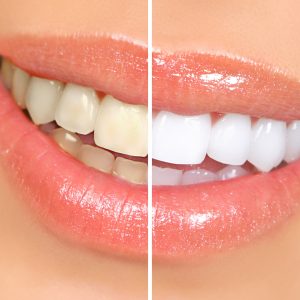 Before-and-after-teeth-whitening Before-and-after-teeth-whitening