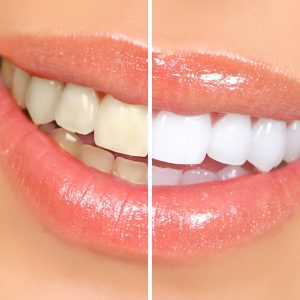 Before-and-after-teeth-whitening