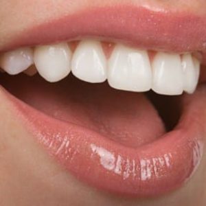 Porcelain Veneers