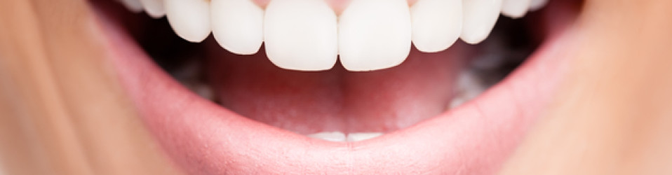 Invisalign